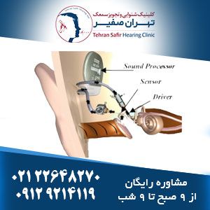 مشکلات کاشت سمعک در گوش میانی