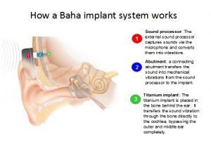 جراحی میکروتیا چگونه انجام می شود؟