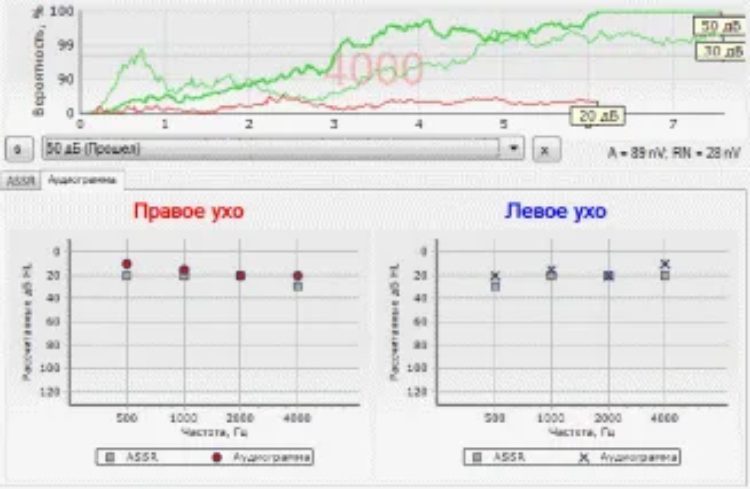 کاربرد تست ASSR در تشخیص مشکلات شنوایی