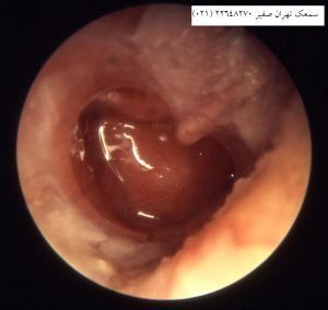 عوارض بیماری گوش میانی