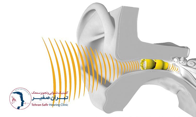 انواع سمعک زیمنس موجود در بازار ایران