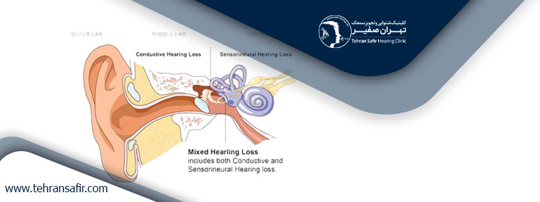 اختلال شنوایی چیست