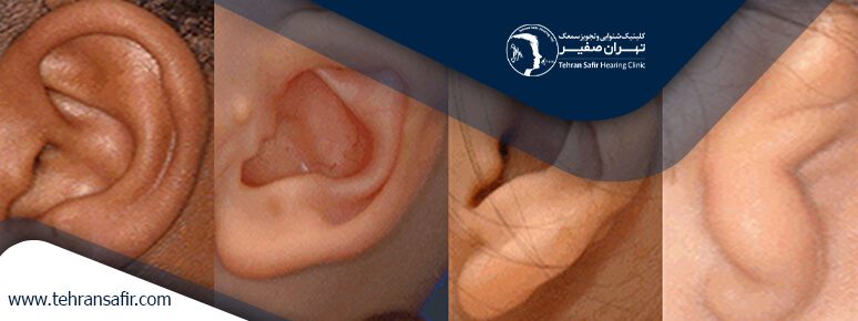 جراحی میکروتیا