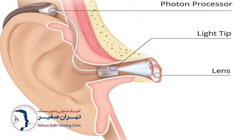 نحوه عملکرد سمعک