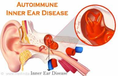 بیماری خودایمنی گوش چیست؟